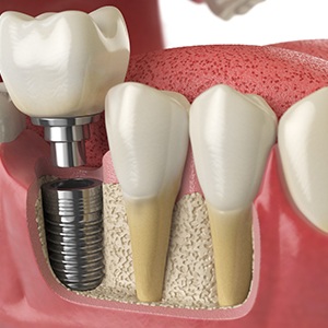 a model of a dental implant in the jaw