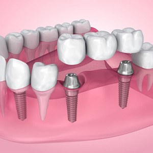 Exploded illustration of dental implants with bridge