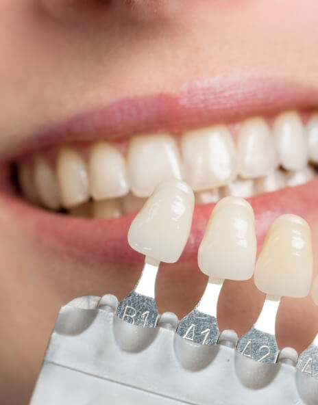 Close up of veneer color chart in front of smile