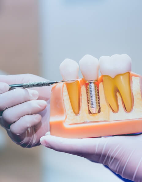 Dentist gesturing to a model of a dental implant