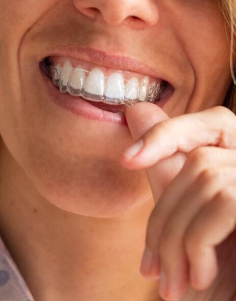 Close up of person placing Invisalign tray over their teeth