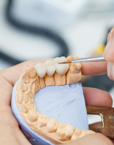 Person crafting a dental bridge in a model of the mouth