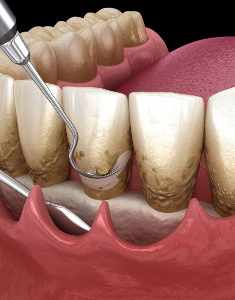 Illustrated dental instruments performing scaling and root planing