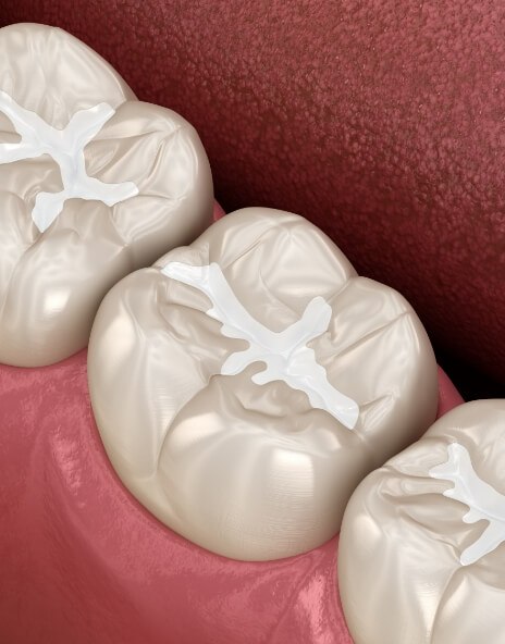 Illustrated row of teeth with dental sealants