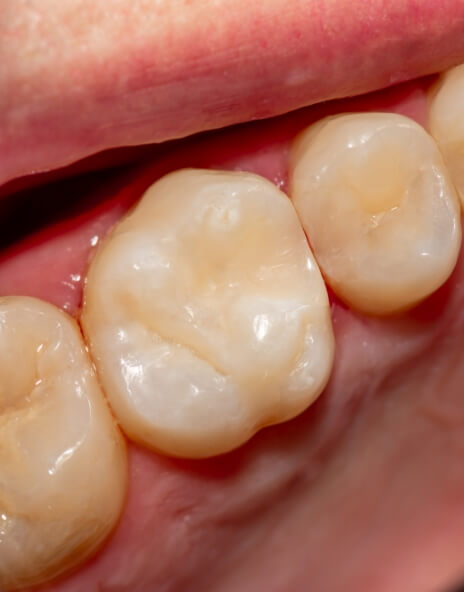 Close up of tooth with a tooth colored filling