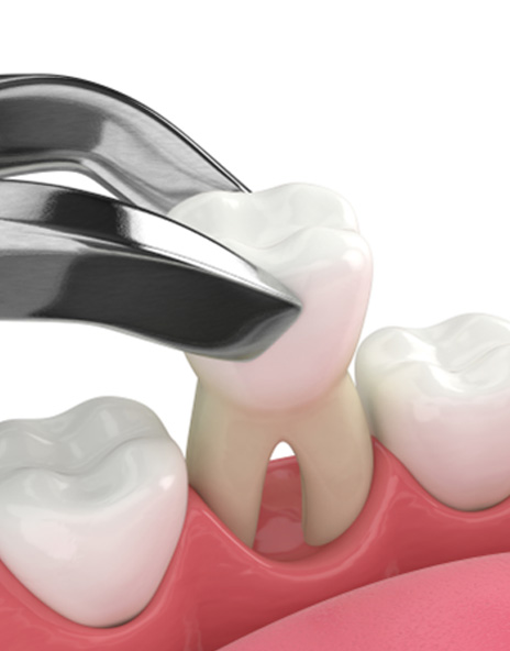 Illustration of a tooth extraction