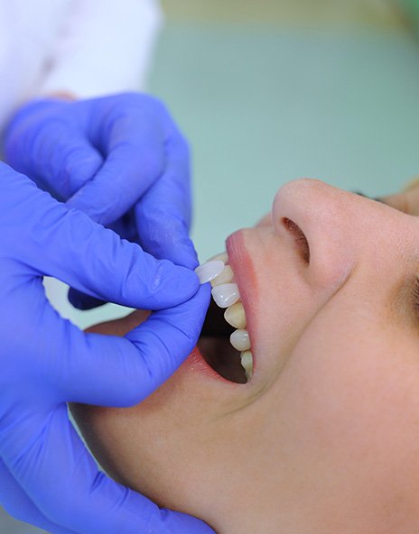 Young woman before and after veneers